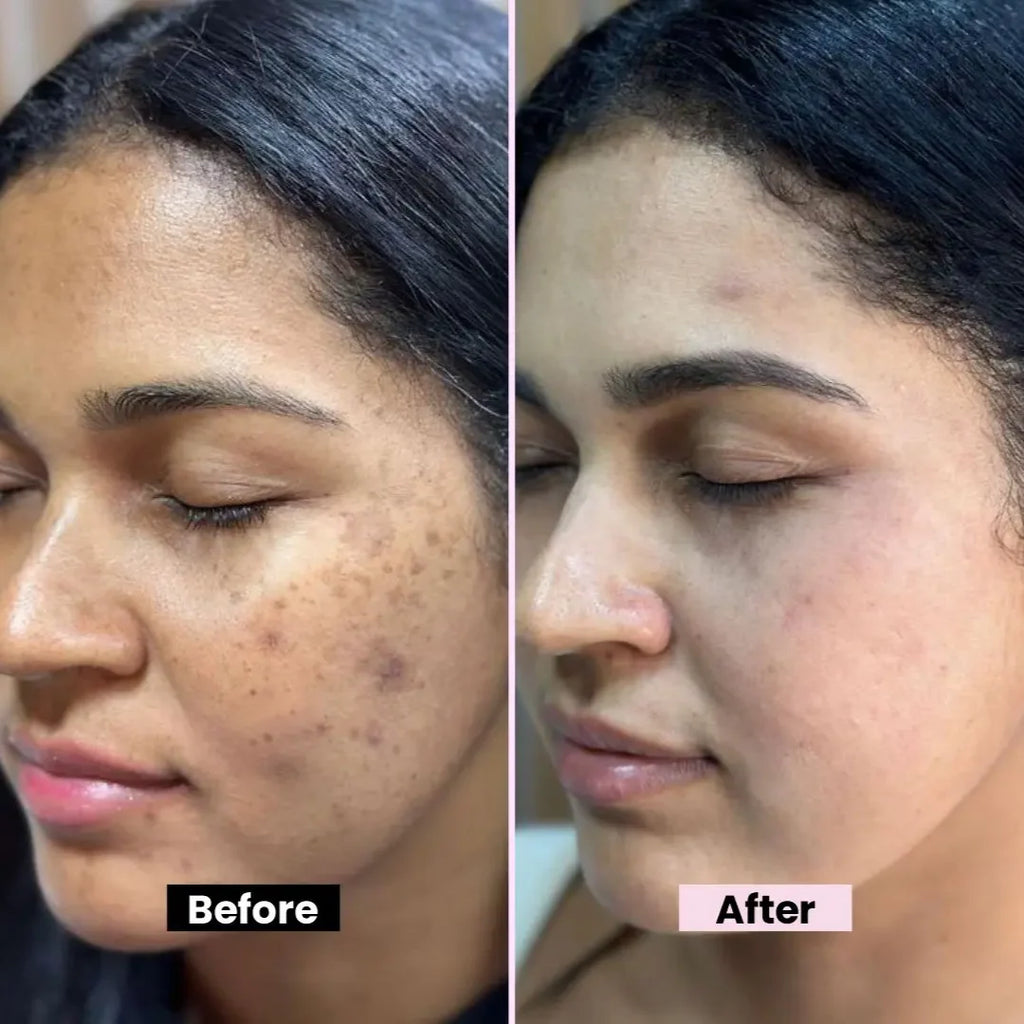 Chalonese Advanced Spot Fading Glow Cream For Radiant Brightening And Even Skin Tone With Daily Care - 20g
